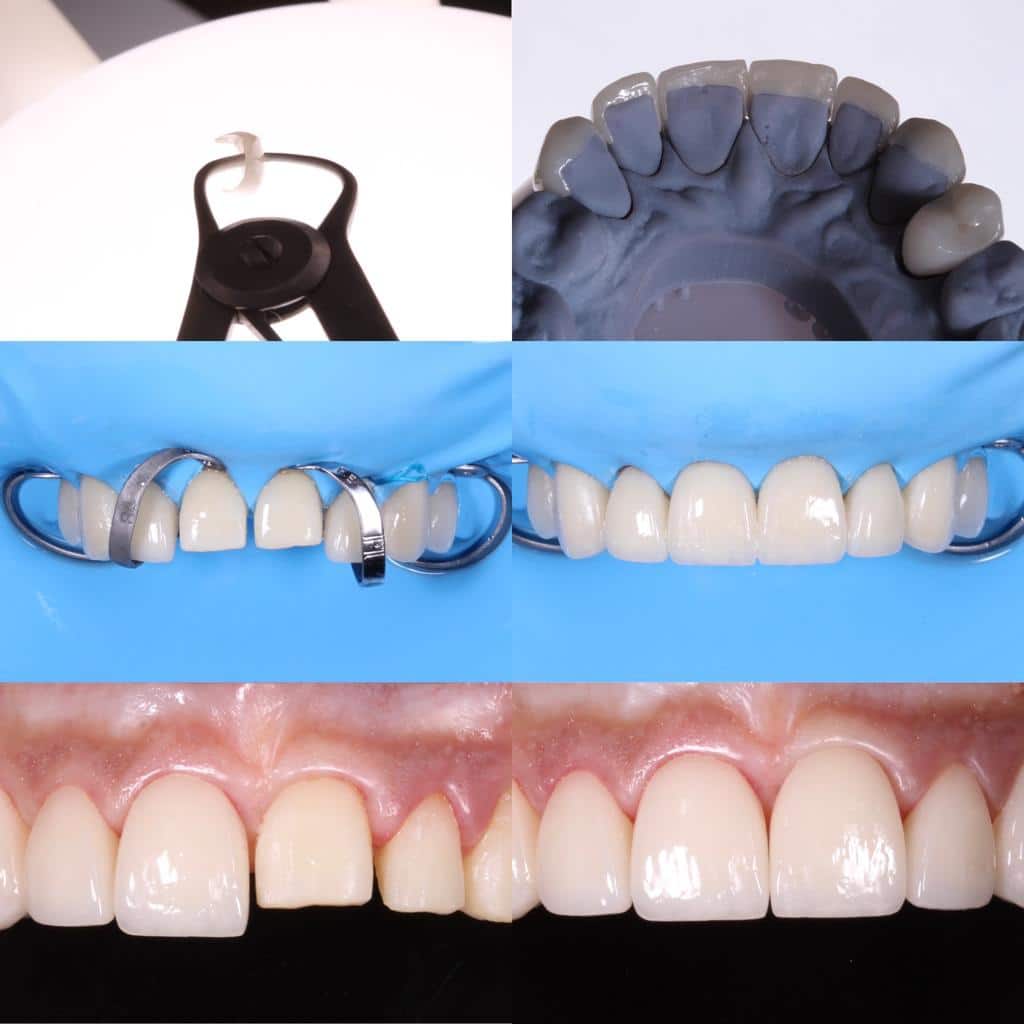 Carillas y Coronas Dentales Panajachel Guatemala Clinicas la Guardia