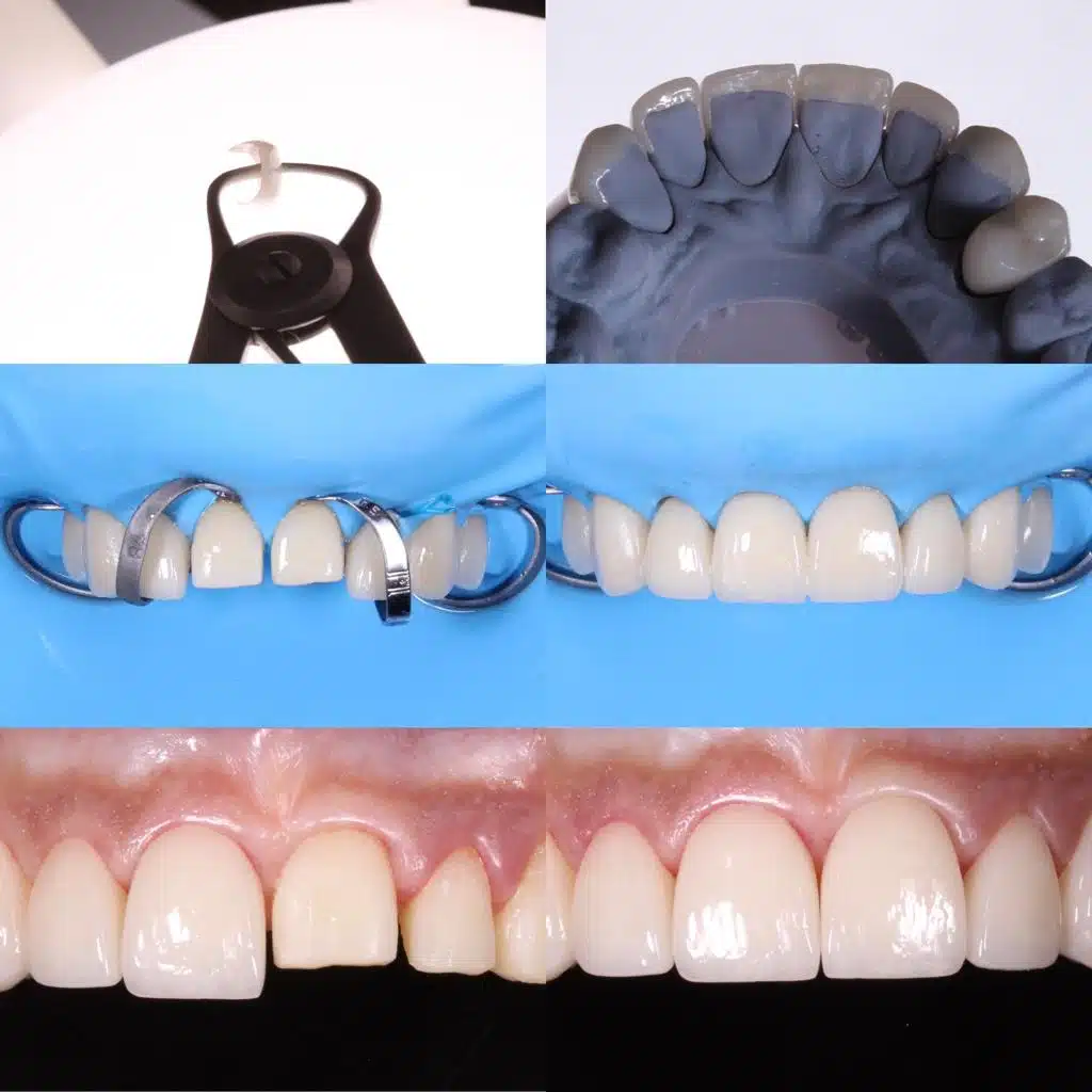 Carillas y Coronas Dentales Panajachel Guatemala Clinicas la Guardia