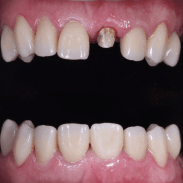 Carillas y Coronas Dentales Panajachel Guatemala Clinicas la Guardia