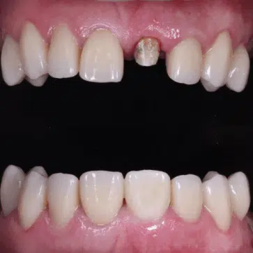 Carillas y Coronas Dentales Panajachel Guatemala Clinicas la Guardia