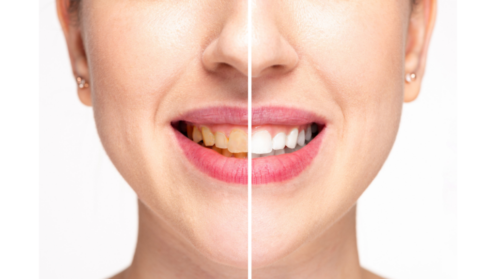 What is Teeth Whitening?