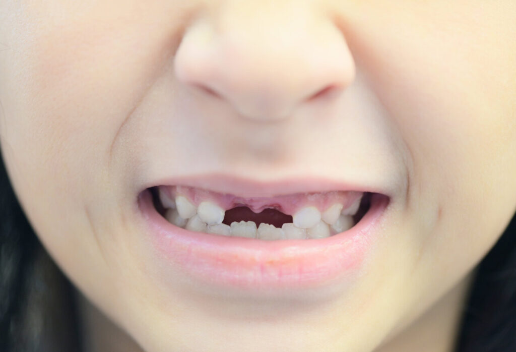 ¿Qué son los dientes de leche?