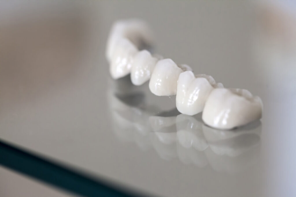 ¿Qué son los puentes dentales?