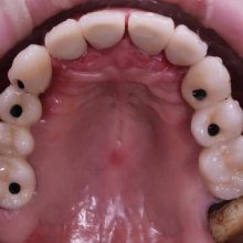 Implante Dental Guatemala Clinicas la Guardia