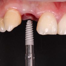 Implante Dental Guatemala Clinicas la Guardia