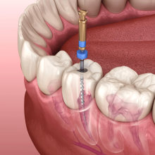 Endodoncia Guatemala