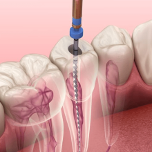 Endodoncia Guatemala