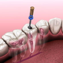 Endodoncia Guatemala